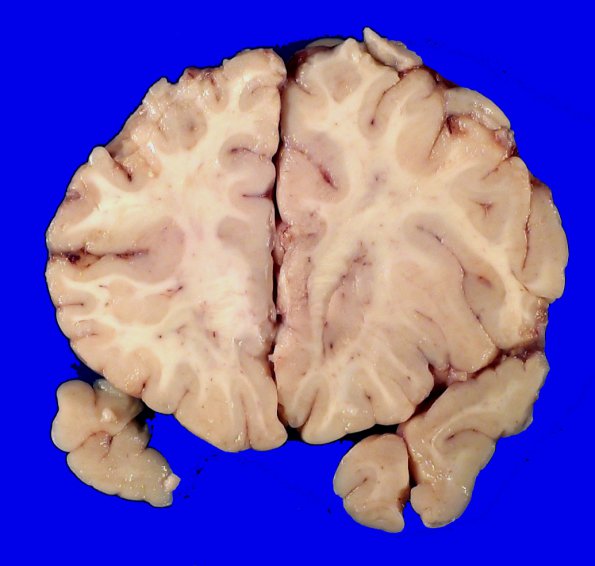 18A1 Heterotopias, hydromyelia (Case 24)_4A