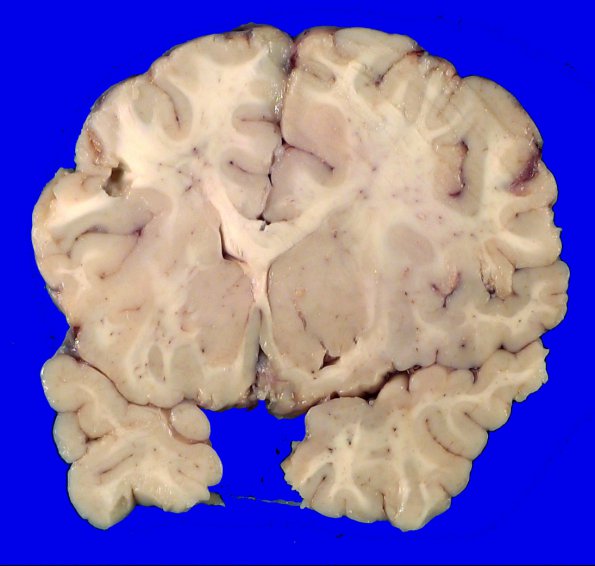 18A2 Heterotopias, hydromyelia (Case 24)_5A