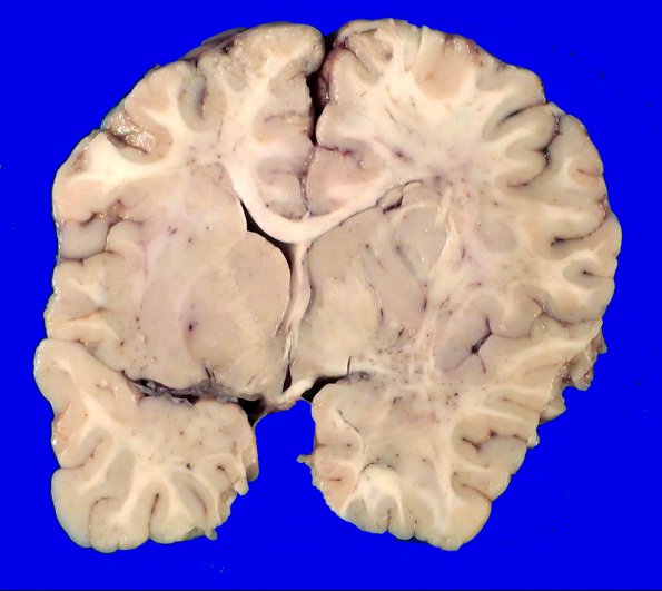 18A3 Heterotopias, hydromyelia (Case 24)_6A