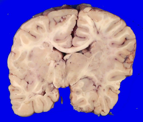 18A4 Heterotopias, hydromyelia (Case 24)_7A