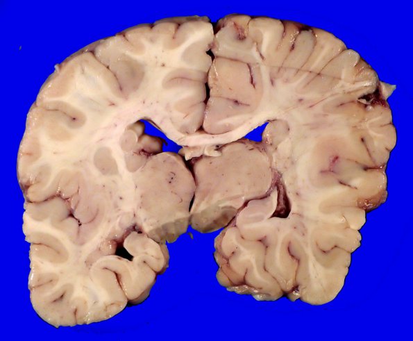 18A5 Heterotopias, hydromyelia (Case 24)_8A