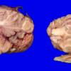 18A6 Heterotopias, hydromyelia (Case 24)_11 AA