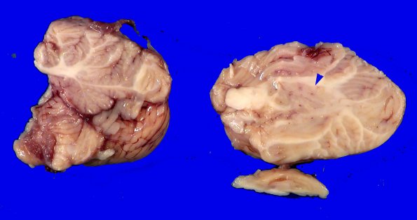 18A6 Heterotopias, hydromyelia (Case 24)_11 AA