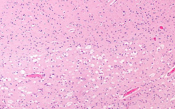 19B3 Heterotopia, incidental (Case 25) N14 H&E 10X