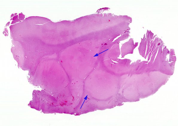 1C1 Heterotopia (Case 1) H&E whole mount 2