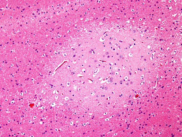 1C3 Heterotopia (Case 1) H&E 1