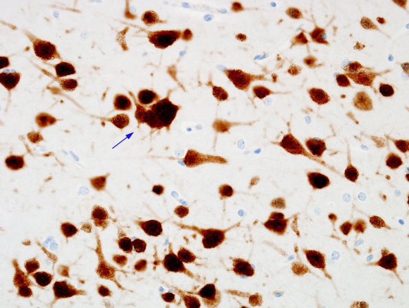 1D3 Heterotopia (Case 1) NeuN 1C heterotopia