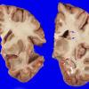 2A1 Heterotopia, periventricular (Case 2) Gross_1A