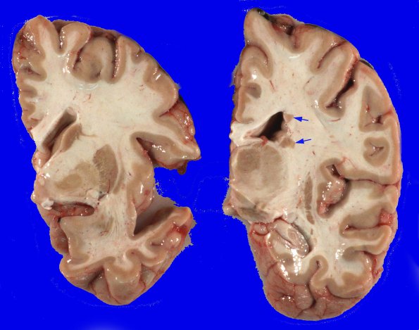 2A1 Heterotopia, periventricular (Case 2) Gross_1A