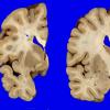 2A2 Heterotopia, periventricular (Case 2) Gross_3A