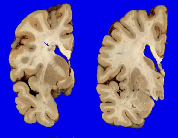 2A2 Heterotopia, periventricular (Case 2) Gross_3A