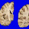 2A3 Heterotopia, periventricular (Case 2) Gross_4A