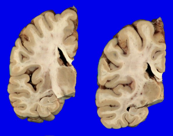 2A3 Heterotopia, periventricular (Case 2) Gross_4A