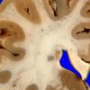 2A4 Heterotopia, periventricular (Case 2) Gross_7A