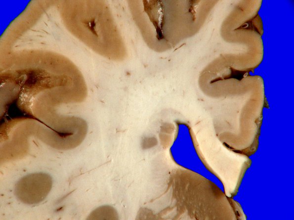 2A4 Heterotopia, periventricular (Case 2) Gross_7A