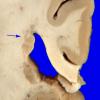 2A5 Heterotopia, periventricular (Case 2) Gross_9A