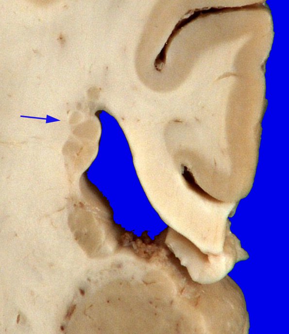 2A5 Heterotopia, periventricular (Case 2) Gross_9A