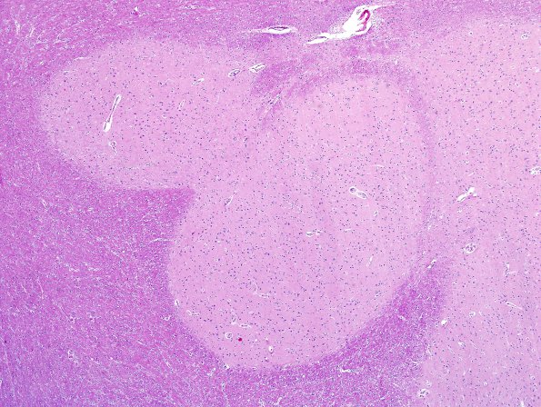 2B2 Heterotopia, neuronal, nodular (Case 2) H&E 4