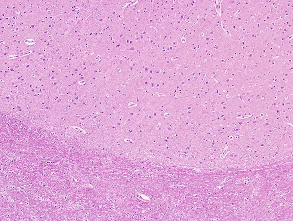 2B3 Heterotopia, neuronal, nodular (Case 2) H&E 2