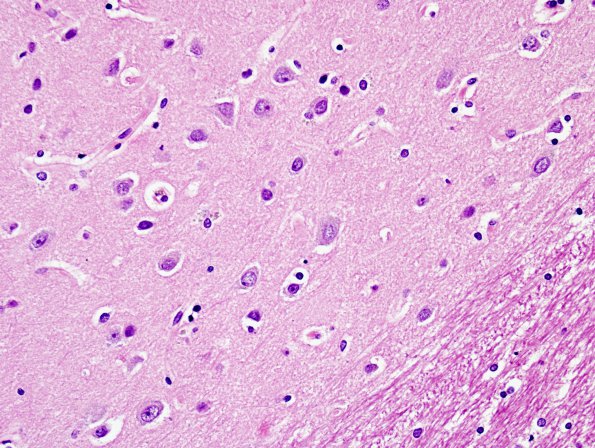 2B4 Heterotopia, neuronal, nodular (Case 2) H&E 11