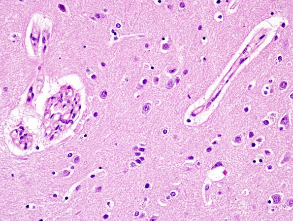 2B5 Heterotopia, neuronal, nodular (Case 2) wickerworks H&E 10