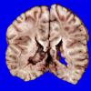 3A1 Heterotopia, nodular periventricular (Case 3) 4A