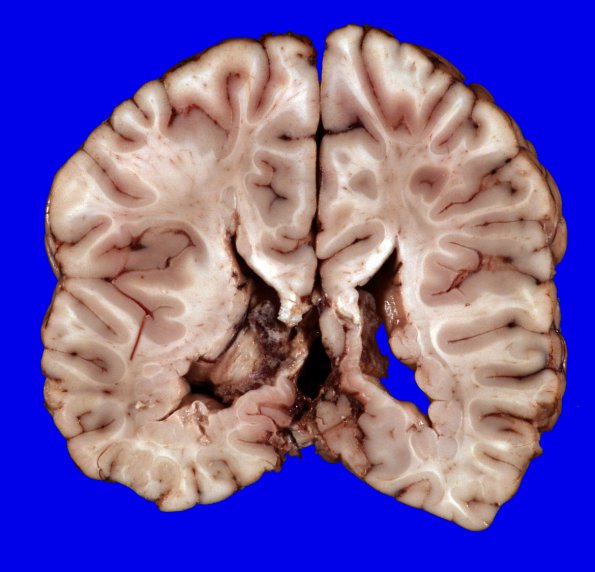 3A1 Heterotopia, nodular periventricular (Case 3) 4A