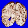 3A10 Heterotopia, nodular periventricular (Case 3) 19A