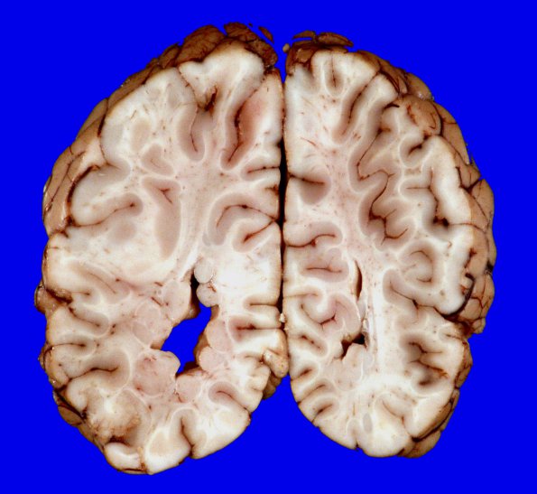 3A10 Heterotopia, nodular periventricular (Case 3) 19A