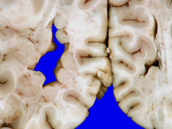 3A11 Heterotopia, nodular periventricular (Case 3) 20A