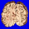 3A12 Heterotopia, nodular periventricular (Case 3) 21A