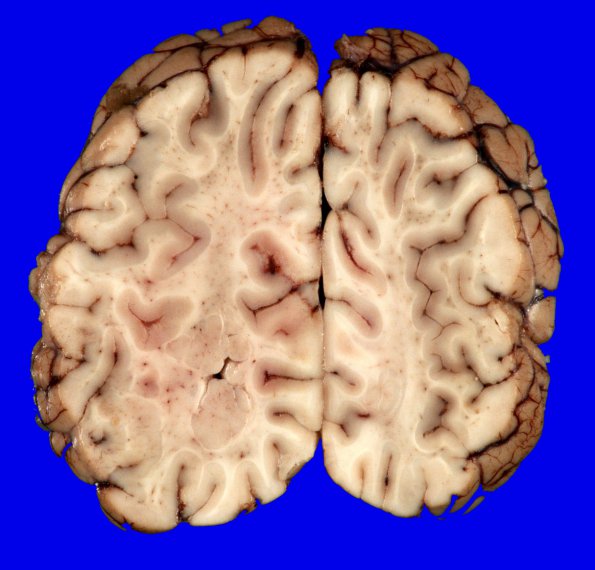 3A12 Heterotopia, nodular periventricular (Case 3) 21A