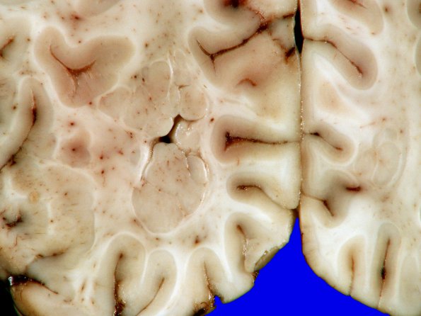 3A13 Heterotopia, nodular periventricular (Case 3) 22A