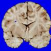 3A2 Heterotopia, nodular periventricular (Case 3) 3A