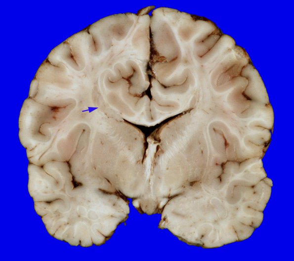 3A2 Heterotopia, nodular periventricular (Case 3) 3A