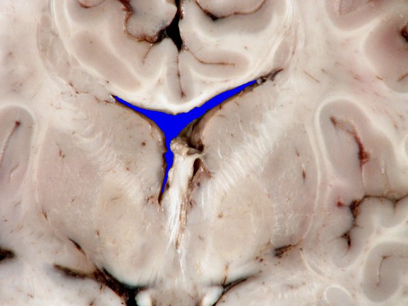 3A3 Heterotopia, nodular periventricular (Case 3) 5A