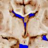 3A4 Heterotopia, nodular periventricular (Case 3) 8A