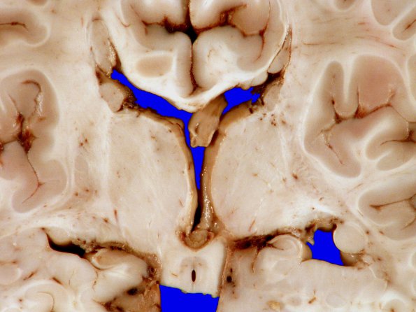 3A4 Heterotopia, nodular periventricular (Case 3) 8A