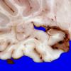 3A5 Heterotopia, nodular periventricular (Case 3) 9A