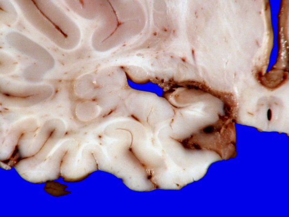 3A5 Heterotopia, nodular periventricular (Case 3) 9A