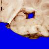 3A6 Heterotopia, nodular periventricular (Case 3) 10A