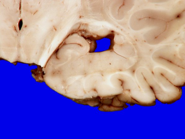 3A6 Heterotopia, nodular periventricular (Case 3) 10A