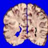 3A7 Heterotopia, nodular periventricular (Case 3) 14A