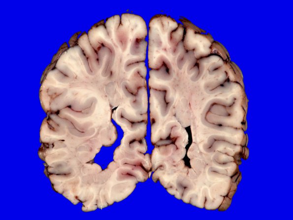 3A7 Heterotopia, nodular periventricular (Case 3) 14A