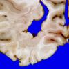 3A8 Heterotopia, nodular periventricular (Case 3) 16A