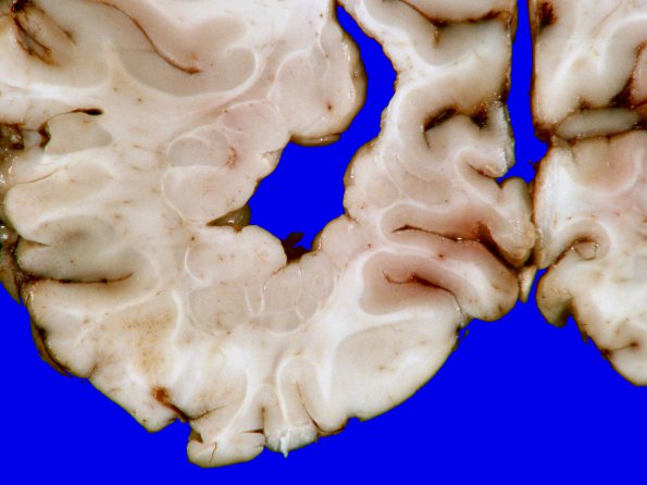 3A8 Heterotopia, nodular periventricular (Case 3) 16A