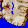 3A9 Heterotopia, nodular periventricular (Case 3) 17A