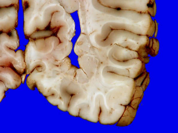 3A9 Heterotopia, nodular periventricular (Case 3) 17A