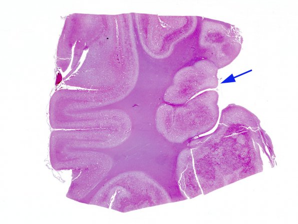 3B Heterotopia, nodular periventricular (Case 3) WM 1