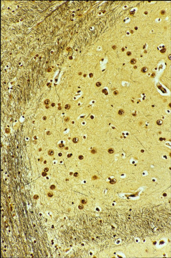 4B3 Heterotopia (Case 4)  46c